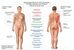 Fibromyalgia Syndrome (Female)