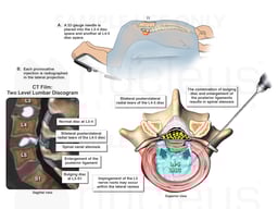 Lumbar Discogram