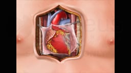Coronary Artery Bypass Graft (CABG)
