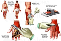 Initial Debridement and Skin Grafting of Burn Injuries