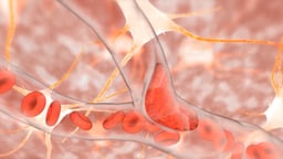 Overview of Ischemic Stroke and Treatment