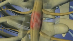 Spinal Cord Schwannoma