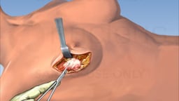 Breast Cancer Surgery - Lumpectomy
