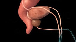 Robotic Prostatectomy