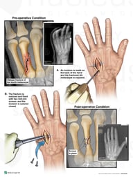 Left Fourth Metacarpal Fracture with Surgical Fixation