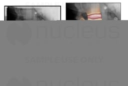 Lumbar Spine Injury