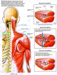 Myofascial Sprain/Strain