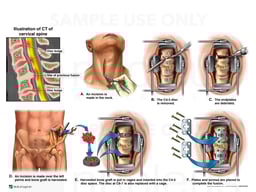 Cervical Spine Injuries with Double Level Anterior Discectomy and Fusion