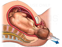 Shoulder Dystocia Using Vacuum Extractor
