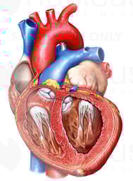 Enlarged Left Ventricle