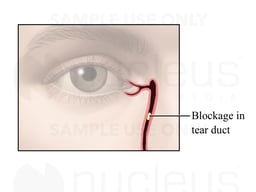 Blockage of the Tear Duct