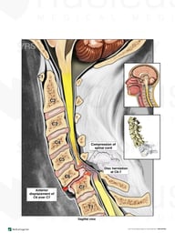 Cervical Spine Injury