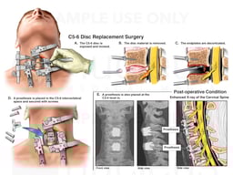 C3-4 and C5-6 Cervical Spine Disc Replacement Surgeries