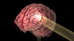 Intensity Modulated Radiation Therapy (IMRT)