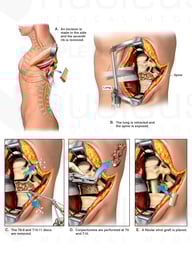 Thoracotomy with T9-10 Corpectomy and Fusion