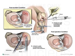 Right Medial Posterior Horn Meniscal Tear with Arthroscopic Repair
