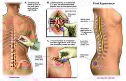 Placement of Thoracic Spinal Cord Stimulator