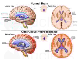 Normal Brain vs. Obstructive Hydrocephalus