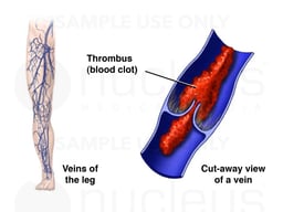Thrombophlebitis