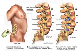 Lumbar Facet Joint Nerve Block