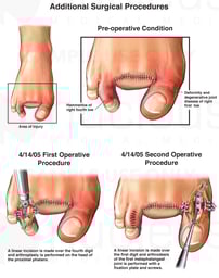 Additional Left Foot and Toe Surgical Procedures