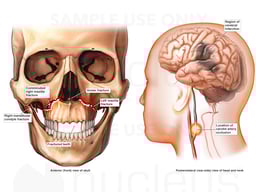Multiple Facial Fractures and Carotid Artery Occlusion with Resulting Cerebral Infarction