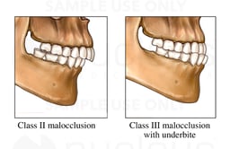 Examples of Malocclusion