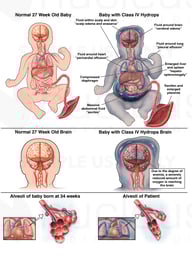 Comparison of Normal 27 Week Gestation to Class IV Hydrops