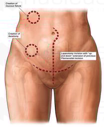 Female Abdomen with Sites of Multiple Abdominal Surgeries