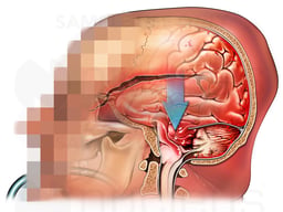 Brain Injury with Uncal Herniation
