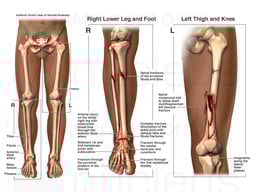 Bilateral Lower Limb Injuries