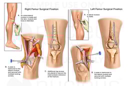 Surgical Fixation of Bilateral Femur Fractures