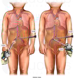 Laparoscopic Trocar Insertions with Severe Vascular Damage