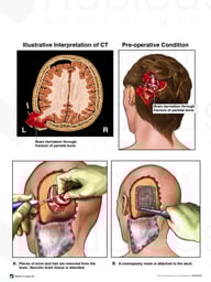 Depressed Skull Fracture with Surgical Repair