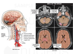 Brain Injury
