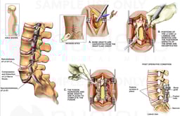 Back Surgery - L5-S1 Spondylolisthesis with Surgical Repair