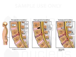 Progression of L4-5 Disc Herniation
