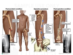 Left Femur Fracture with Surgical Fixation