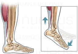 Achilles Tendon: Lateral (Side) View