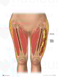 Left Lateral Thigh Abscess