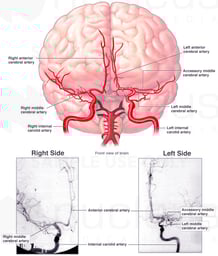 Cerebral Arteriograms