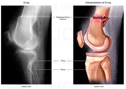 Distal Left Femur Fracture