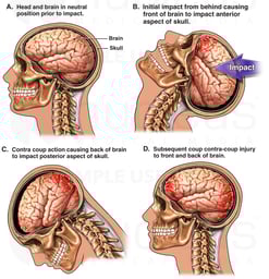 Whiplash - Traumatic Closed Head Injury