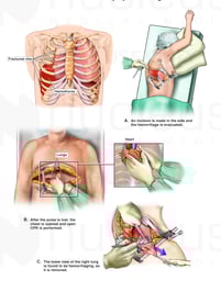 Traumatic Chest Injury with Surgical Thoracotomy and Lobectomy