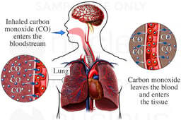 Lungs - Carbon Monoxide Gas Poisoning