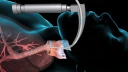 Endotracheal Intubation with Laryngoscope and Tube Placement