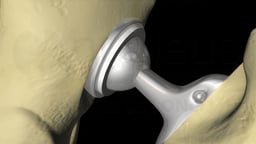 Total Hip Replacement