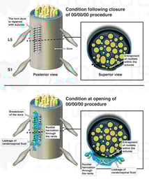 Breakdown of Dural Repair Site