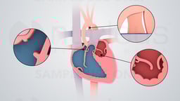 Hypoplastic Left Heart Syndrome