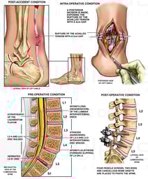 Rupture of the Achilles Tendon and Lower Back Injuries with Surgical Repairs
